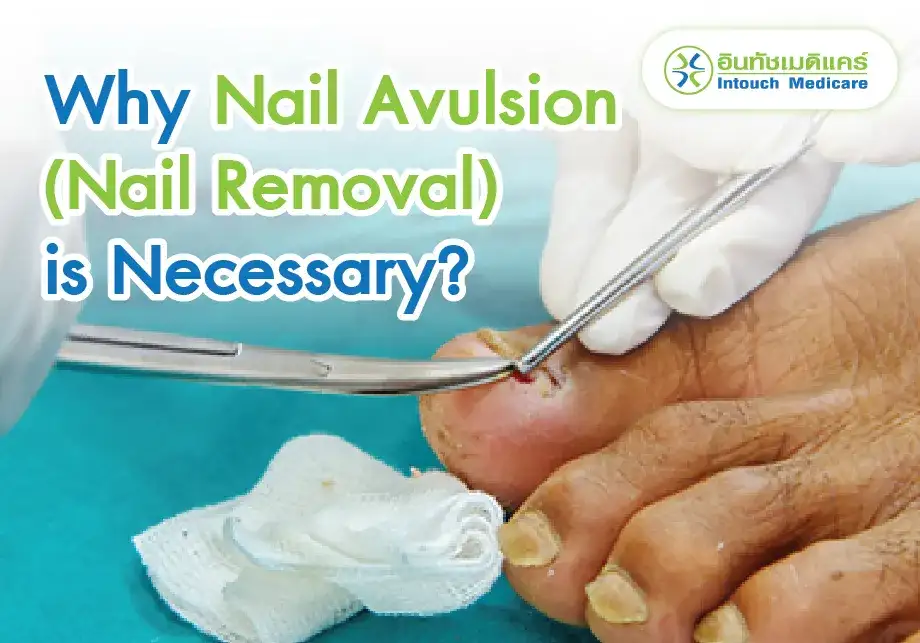 Why Nail Avulsion (Nail Removal) is Necessary?