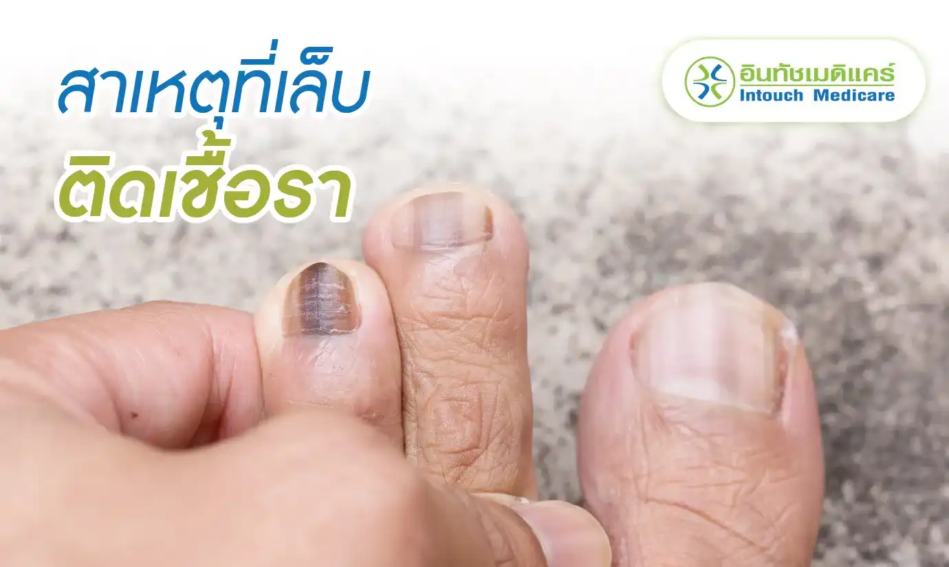 เชื้อราที่เล็บเกิดจากอะไร? เชื้อราที่เล็บเกิดจากอะไร?