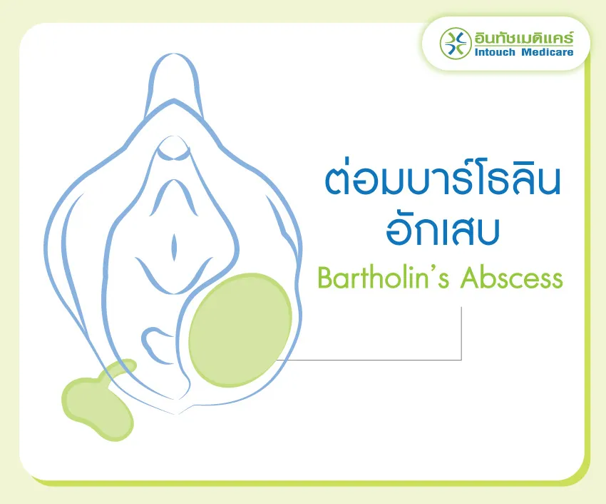 ต่อมบาร์โธลินอักเสบ เกิดจากอะไร ต่อมบาร์โธลินอักเสบ เกิดจากอะไร