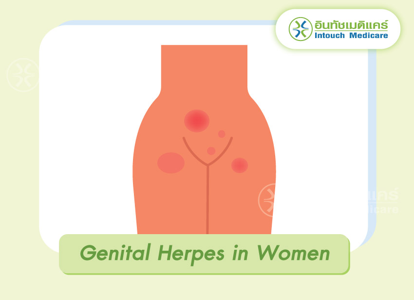 Genital Herpes in Women