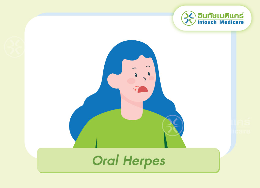 Oral Herpes