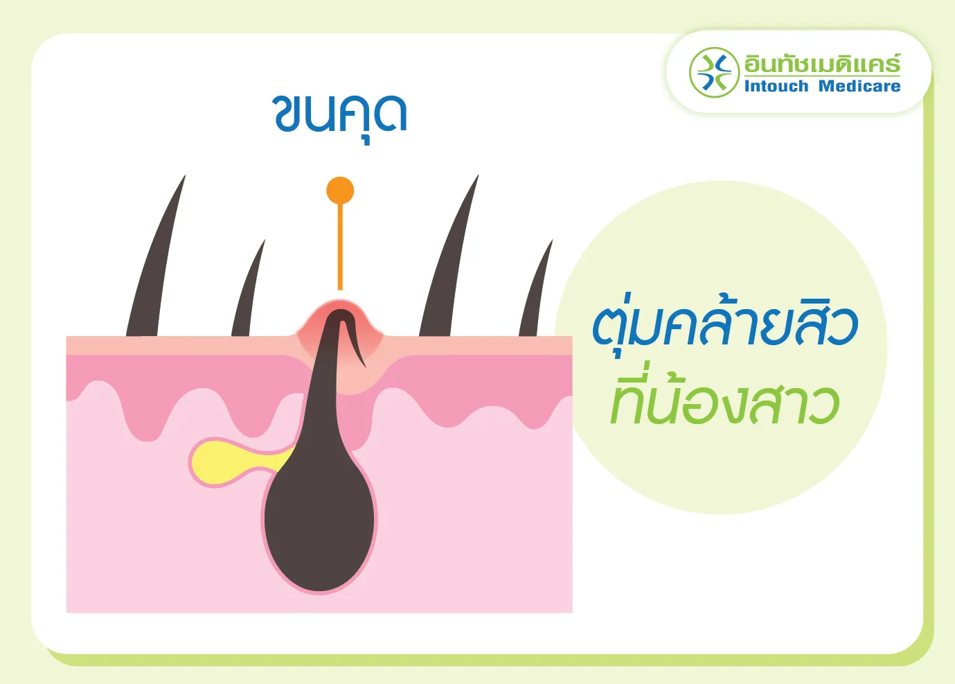 ตุ่มคล้ายสิวขึ้นที่น้องสาว ที่เกิดจากขนคุด ตุ่มคล้ายสิวขึ้นที่น้องสาว ที่เกิดจากขนคุด