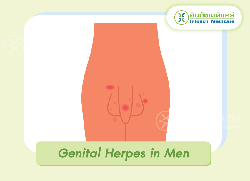 Genital Herpes in Men