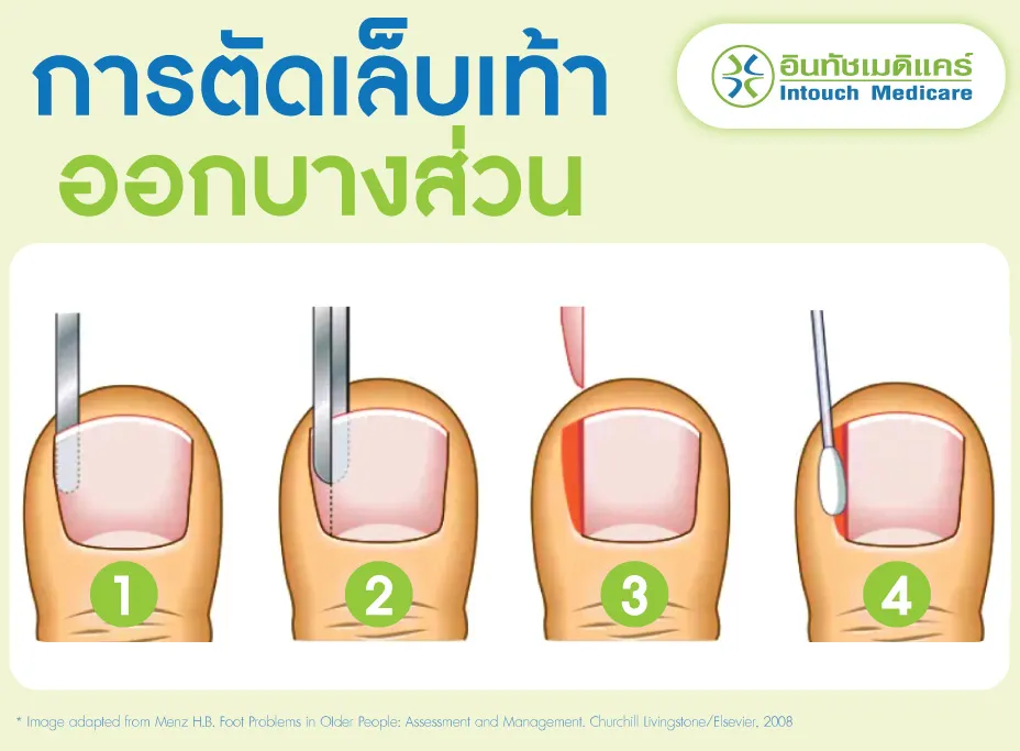 การตัดเล็บเท้าที่ขบออกบางส่วน การตัดเล็บเท้าที่ขบออกบางส่วน