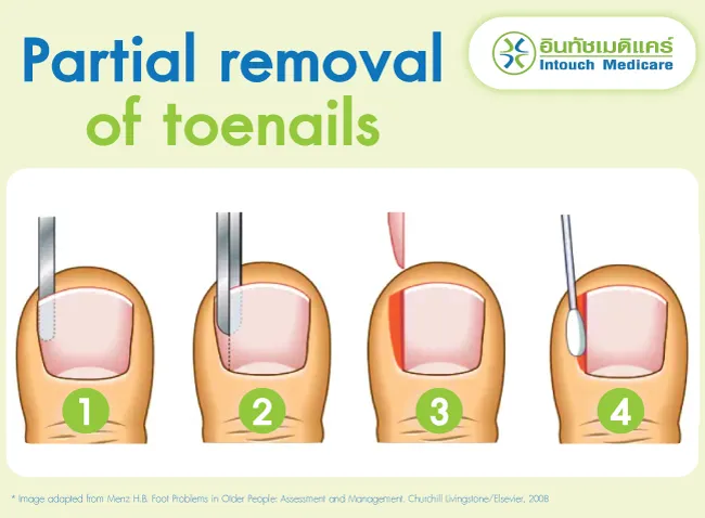 Toe Nail Roots What causes ingrown toenails? Symptoms and treatment - intouchmedicare