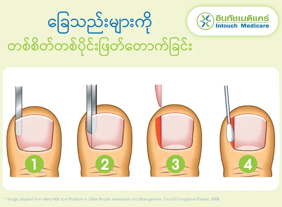 partial nail excision  partial nail excision