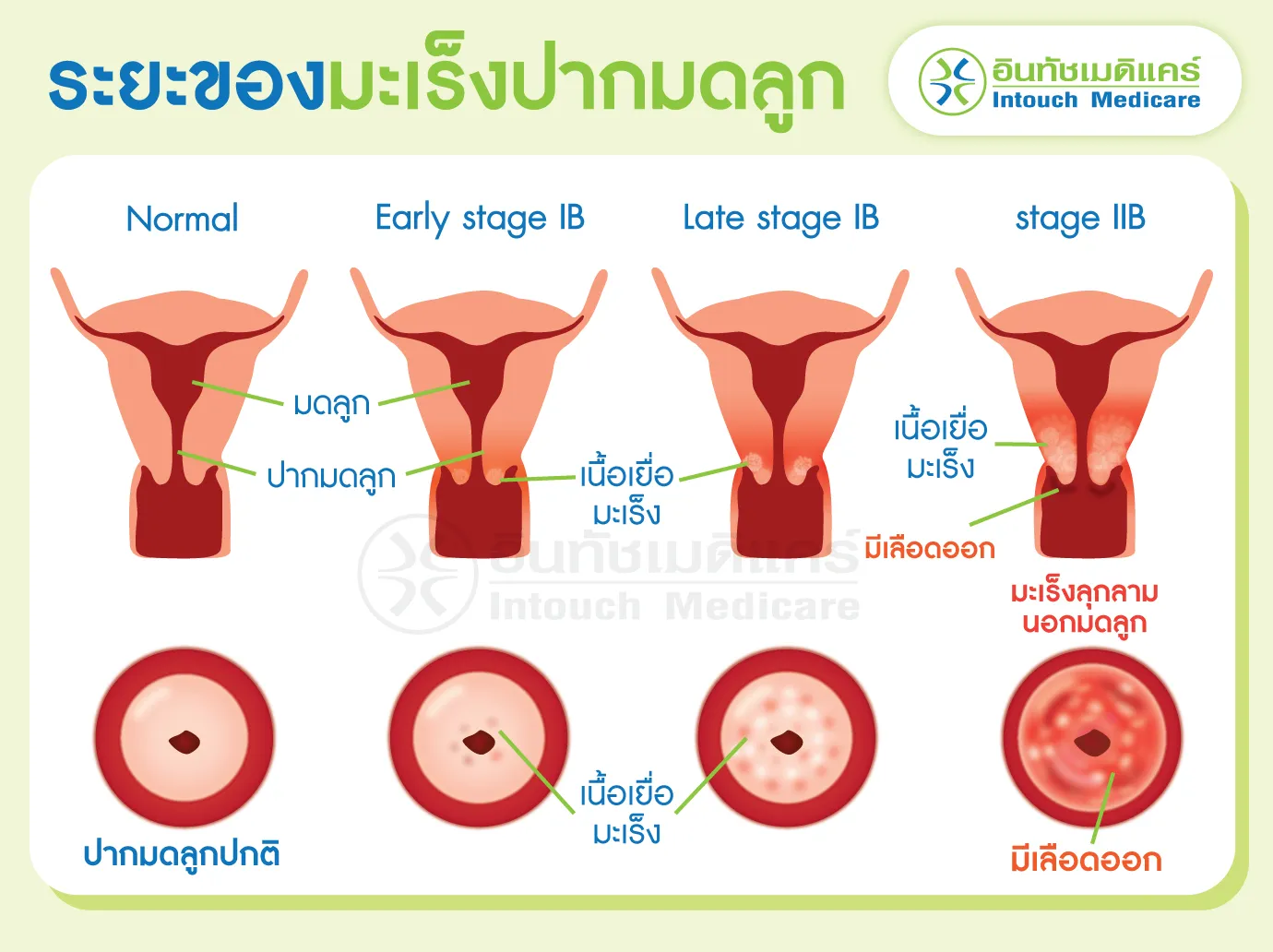 ระยะของมะเร็งปากมดลูก ระยะของมะเร็งปากมดลูก