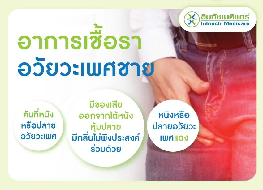 เชื้อราอวัยวะเพศชาย เป็นแล้วรักษาได้ไหม? - intouchmedicare