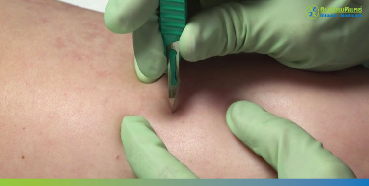 ถอดยาคุมแบบฝังออกยาก ถอดยาคุมแบบฝังออกยาก