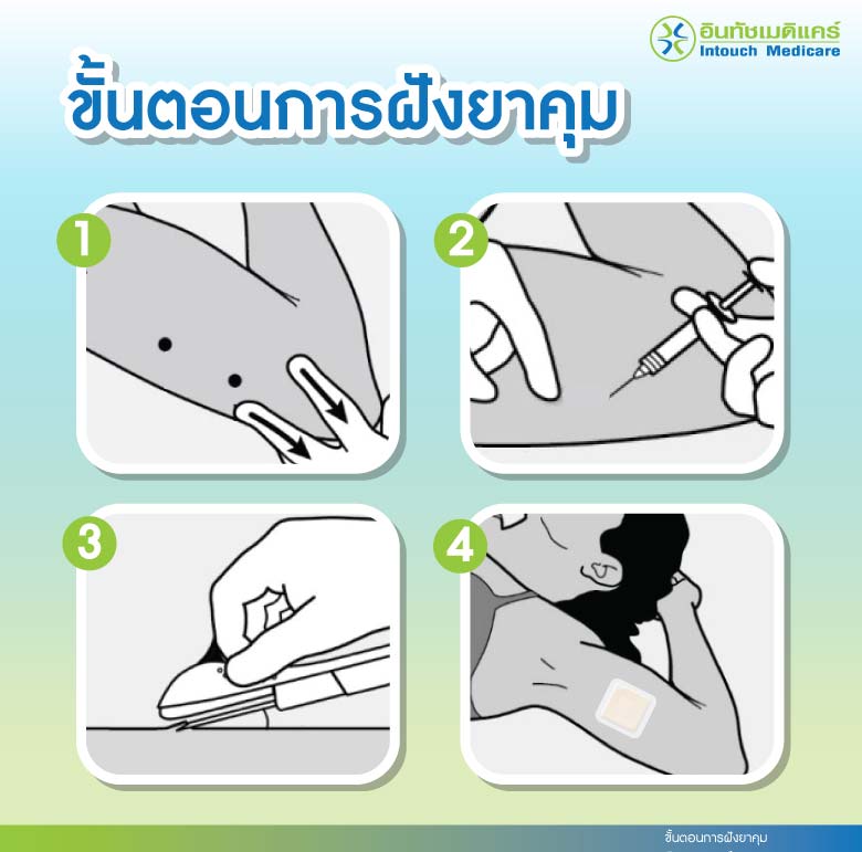 ขั้นตอนการฝังยาคุม