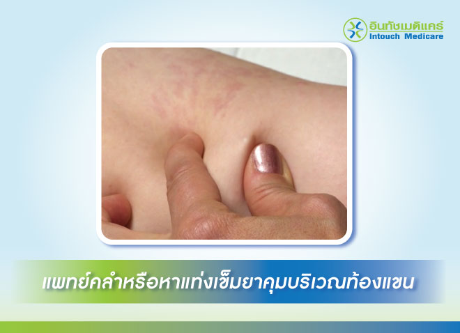 แพทย์คลำหรือหาแท่งเข็มยาคุมบริเวณท้องแขน แพทย์คลำหรือหาแท่งเข็มยาคุมบริเวณท้องแขน