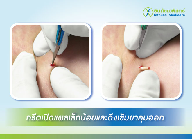 กรีดเปิดแผลเล็กน้อยและดึงเข็มยาคุมออก กรีดเปิดแผลเล็กน้อยและดึงเข็มยาคุมออก