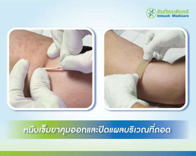 หนีบเข็มยาคุมออกและปิดแผลบริเวณที่ถอด หนีบเข็มยาคุมออกและปิดแผลบริเวณที่ถอด