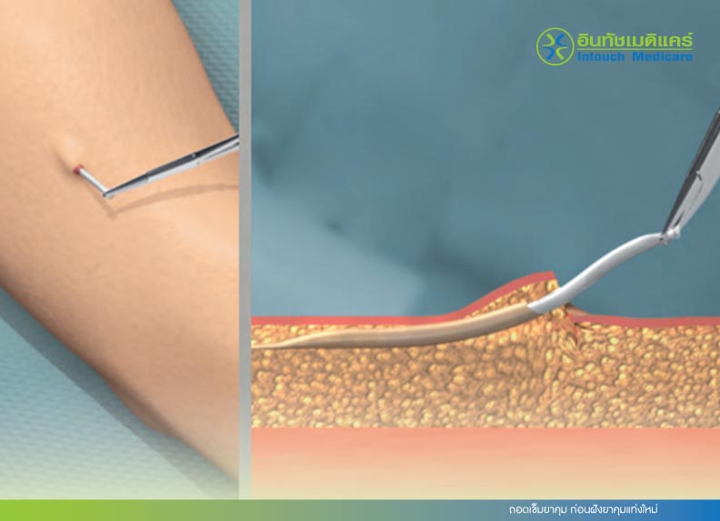 ถอดเข็มยาคุม ก่อนฝังยาคุมแท่งใหม่