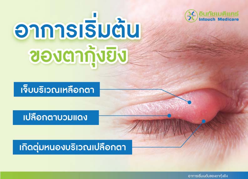 อาการเริ่มต้นของตากุ้งยิง อาการเริ่มต้นของตากุ้งยิง