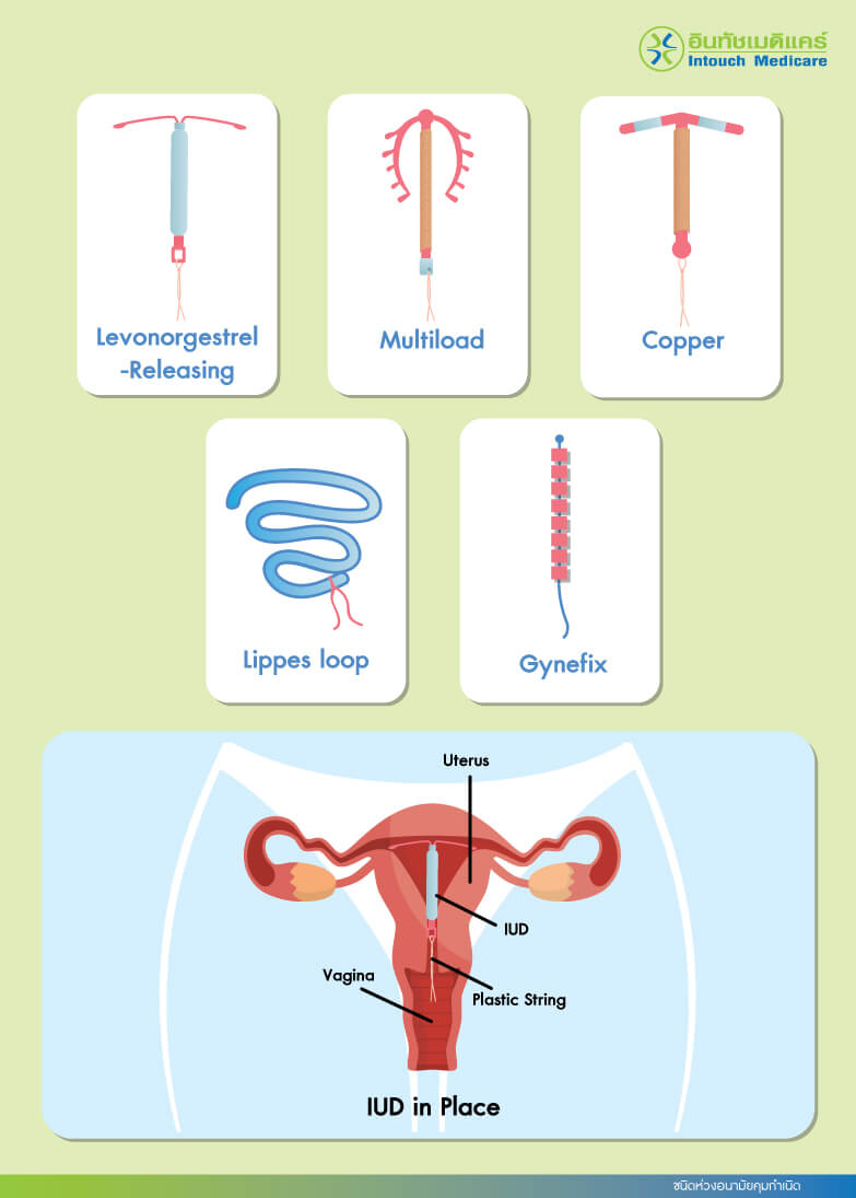ชนิดห่วงอนามัยคุมกำเนิด