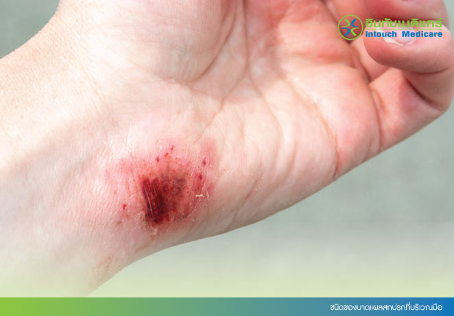 ชนิดของบาดแผลสกปรกที่บริเวณมือ