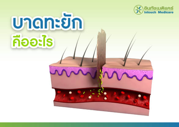 บาดทะยักคืออะไร บาดทะยักคืออะไร
