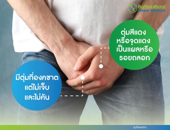 ตุ่มที่องคาต ตุ่มที่องคาต