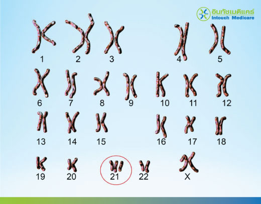 ตรวจดาวน์ซินโดรม คืออะไร ตรวจดาวน์ซินโดรม คืออะไร