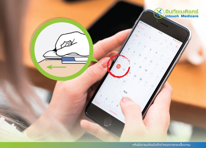 บันทึกวันที่ถอดยาฝังคุมกำเนิด