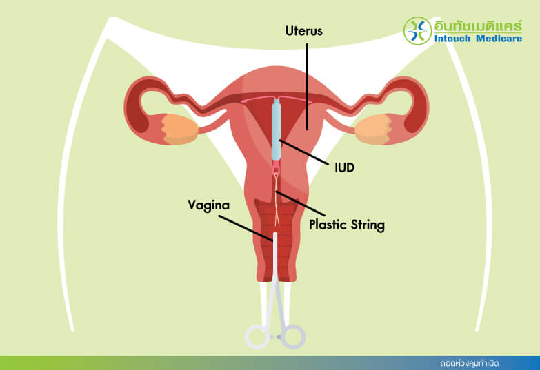 ถอดห่วงคุมกำเนิด