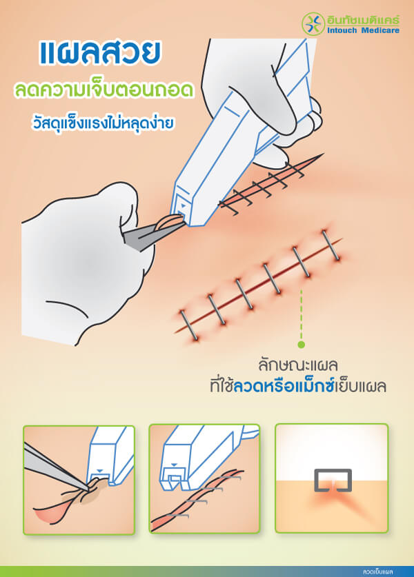 ลวดเย็บแผล ลวดเย็บแผล