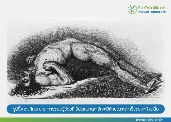 อาการของโรคบาดทะยัก อาการของโรคบาดทะยัก