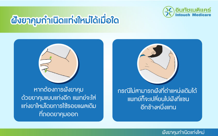 ฝังยาคุมแท่งใหม่ ฝังยาคุมแท่งใหม่