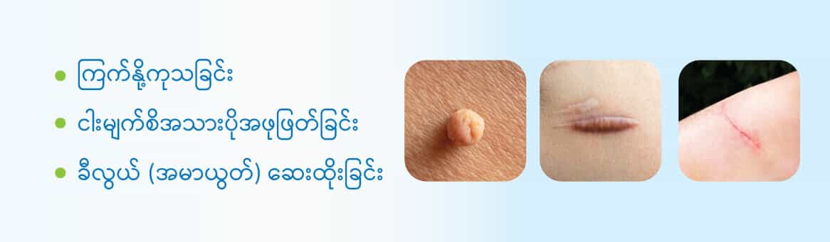 Wart-pendant-keloid-injection-polyp-removal ကြက်နို့ကုသခြင်း ငါးမျက်စိအသားပိုအဖုဖြတ်ခြင်း ခီလွယ် (အမာယွတ်) ဆေးထိုးခြင်း