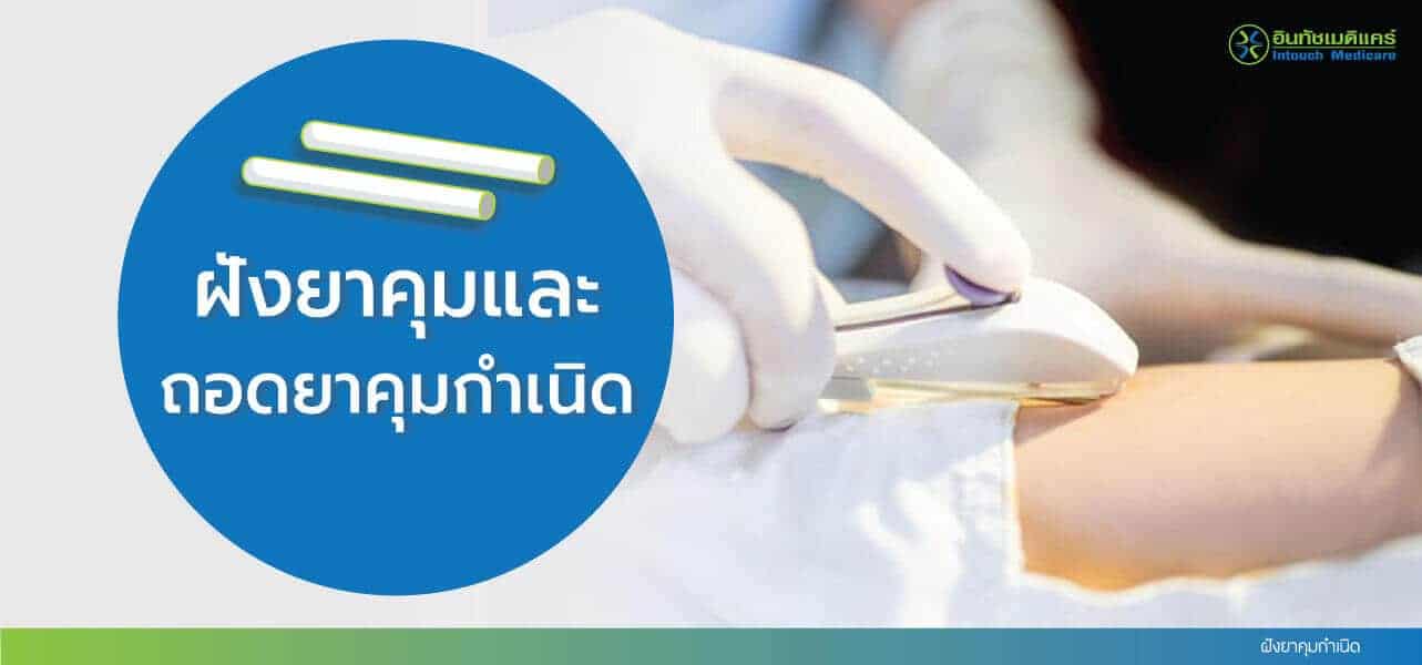 ฝังยาคุม (ฝั่งยาคุม) และถอดยาคุม