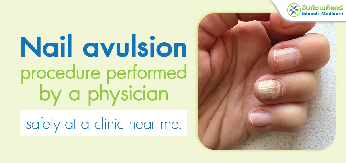 Nail avulsion (Nail Removal) procedure performed by a physician Nail avulsion (Nail Removal) procedure performed by a physician