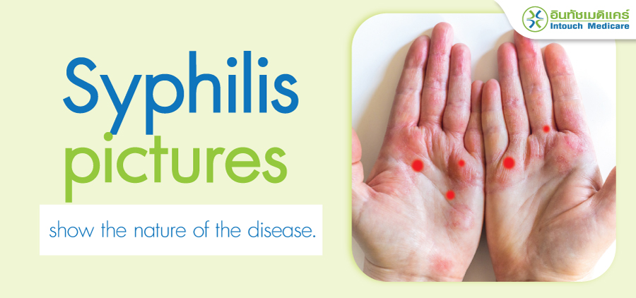 Syphilis pictures