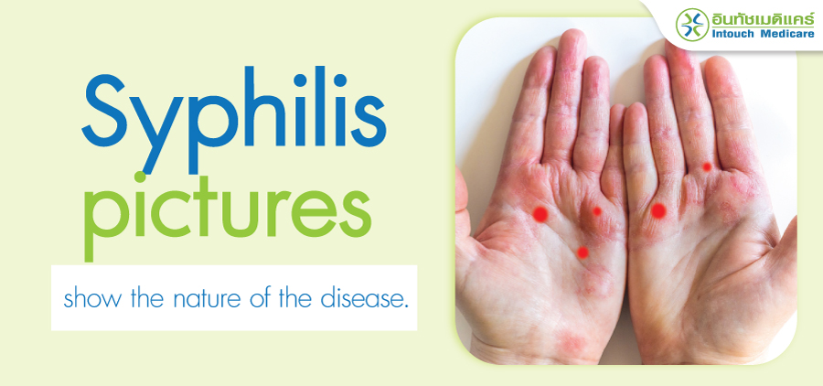 Syphilis pictures Syphilis pictures