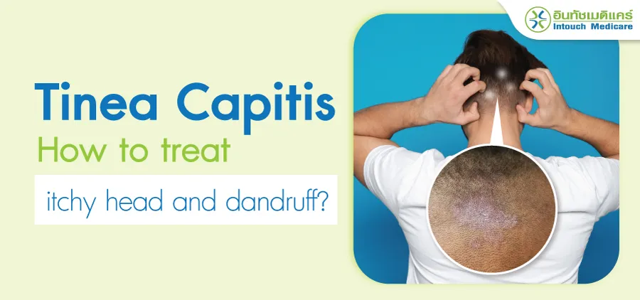 Tinea Capitis How to treat itchy head and dandruff?