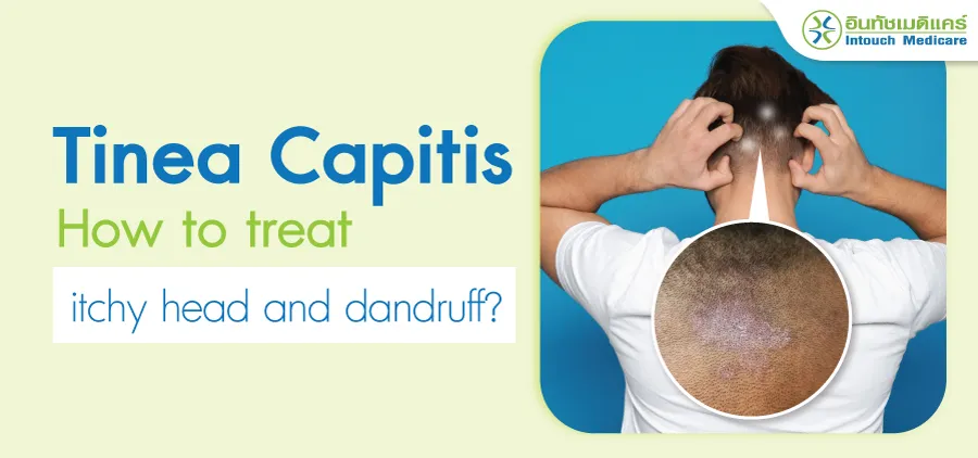 Tinea Capitis How to treat itchy head and dandruff? Tinea Capitis How to treat itchy head and dandruff?