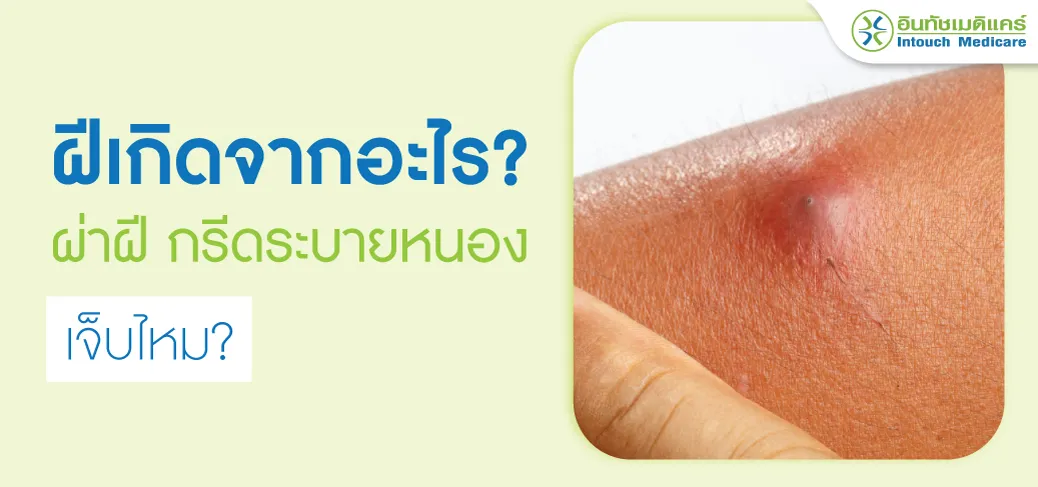 ฝีเกิดจากอะไร ผ่าฝี กรีดระบายหนองเจ็บไหม ฝีเกิดจากอะไร ผ่าฝี กรีดระบายหนองเจ็บไหม