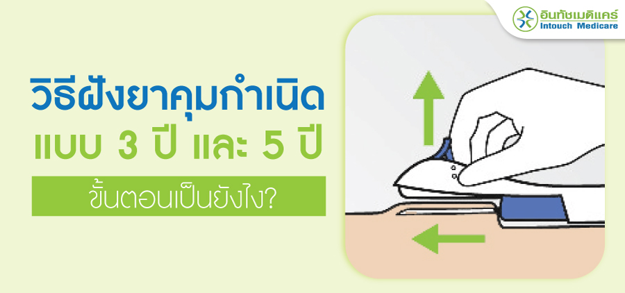 วิธีฝังยาคุมกำเนิด วิธีฝังยาคุมกำเนิด