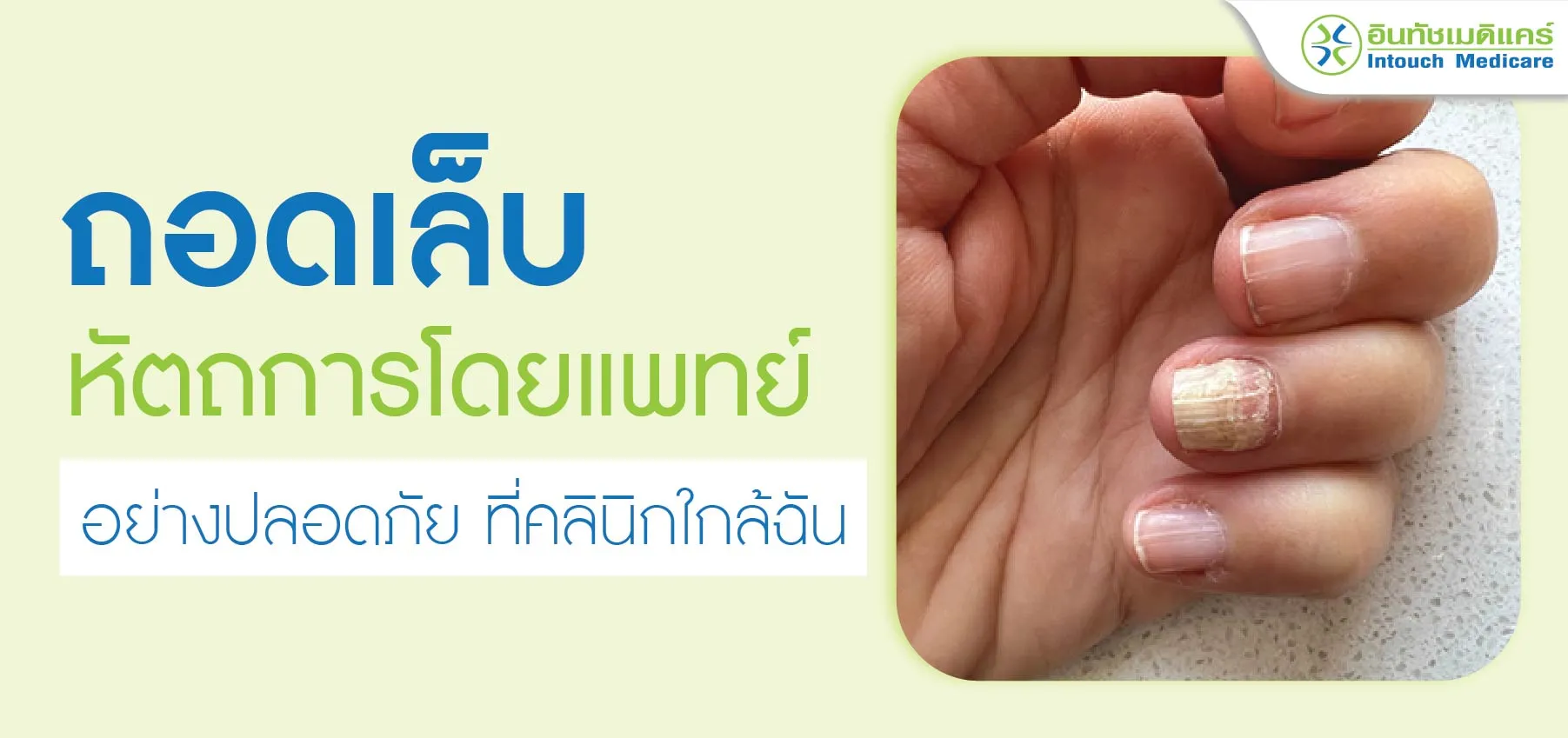 ถอดเล็บ อย่างปลอดภัย ที่คลินิกใกล้ฉัน ถอดเล็บ อย่างปลอดภัย ที่คลินิกใกล้ฉัน