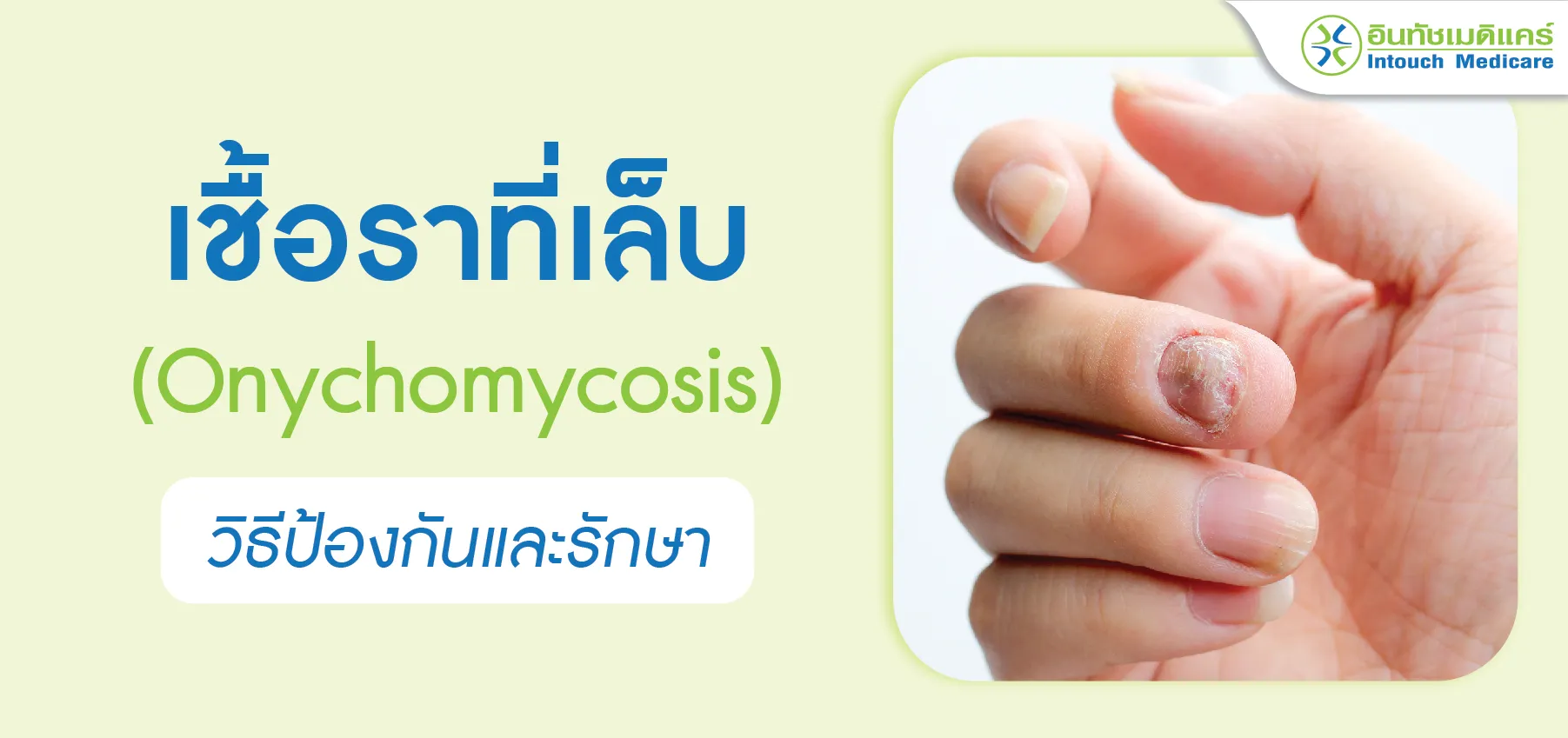 เชื้อราที่เล็บ วิธีป้องกันและรักษา