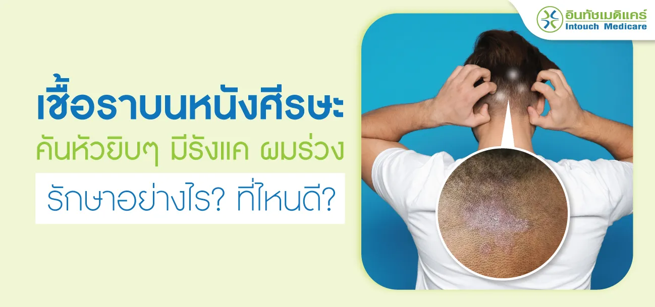 เชื้อราบนหนังศีรษะ เชื้อราบนหนังศีรษะ