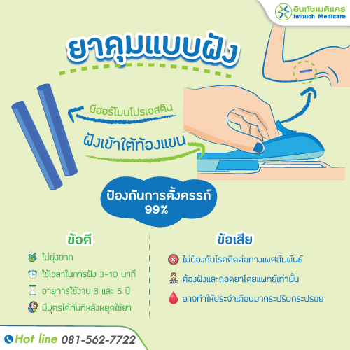ยาคุมแบบฝัง ยาคุมแบบฝัง