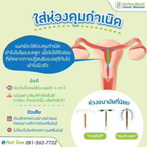ยาคุมแบบห่วง ใส่ห่วงคุมกำเนิด
