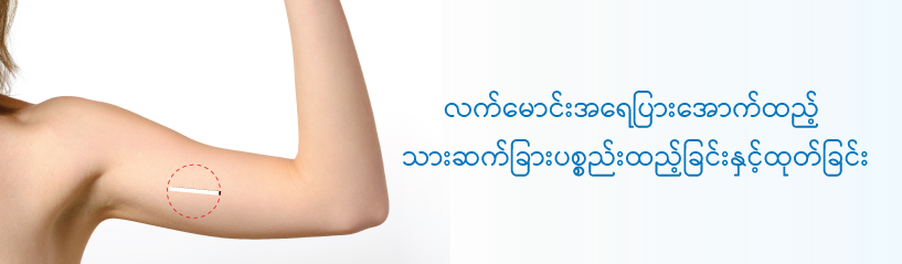 လက်မောင်းအရေပြားအောက်ထည့် သားဆက်ခြားပစ္စည်းထည့်ခြင်းနှင့်ထုတ်ခြင်း လက်မောင်းအရေပြားအောက်ထည့် သားဆက်ခြားပစ္စည်းထည့်ခြင်းနှင့်ထုတ်ခြင်း
