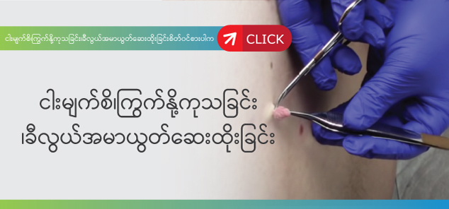 ကြက်နို့/ငါးမျက်စိကုသခြင်း/ခီလွယ်(အမာယွတ်)ဆေးထိုးခြင်း ကြက်နို့/ငါးမျက်စိကုသခြင်း/ခီလွယ်(အမာယွတ်)ဆေးထိုးခြင်း