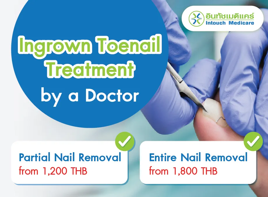 The Cost of Ingrown Toenail Removal