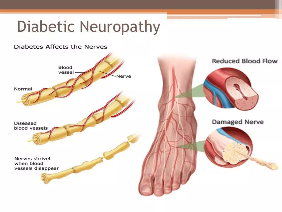 7 symptoms that signal that Diabetic nerves are damaged.