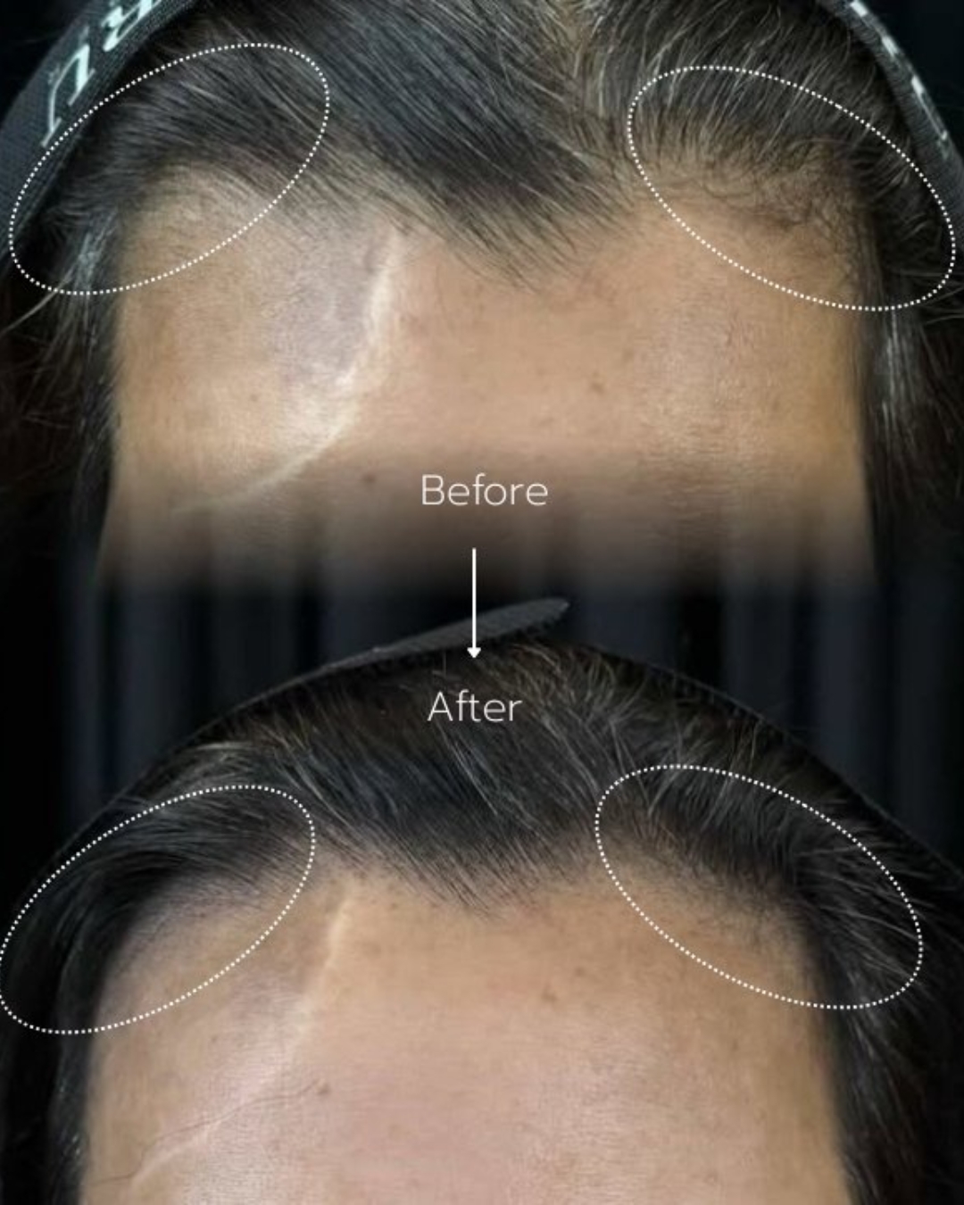 ผลลัพธ์การทำ Scalp Micropigmentation ที่ให้ภาพลวงตาเป็นผมสั้น
