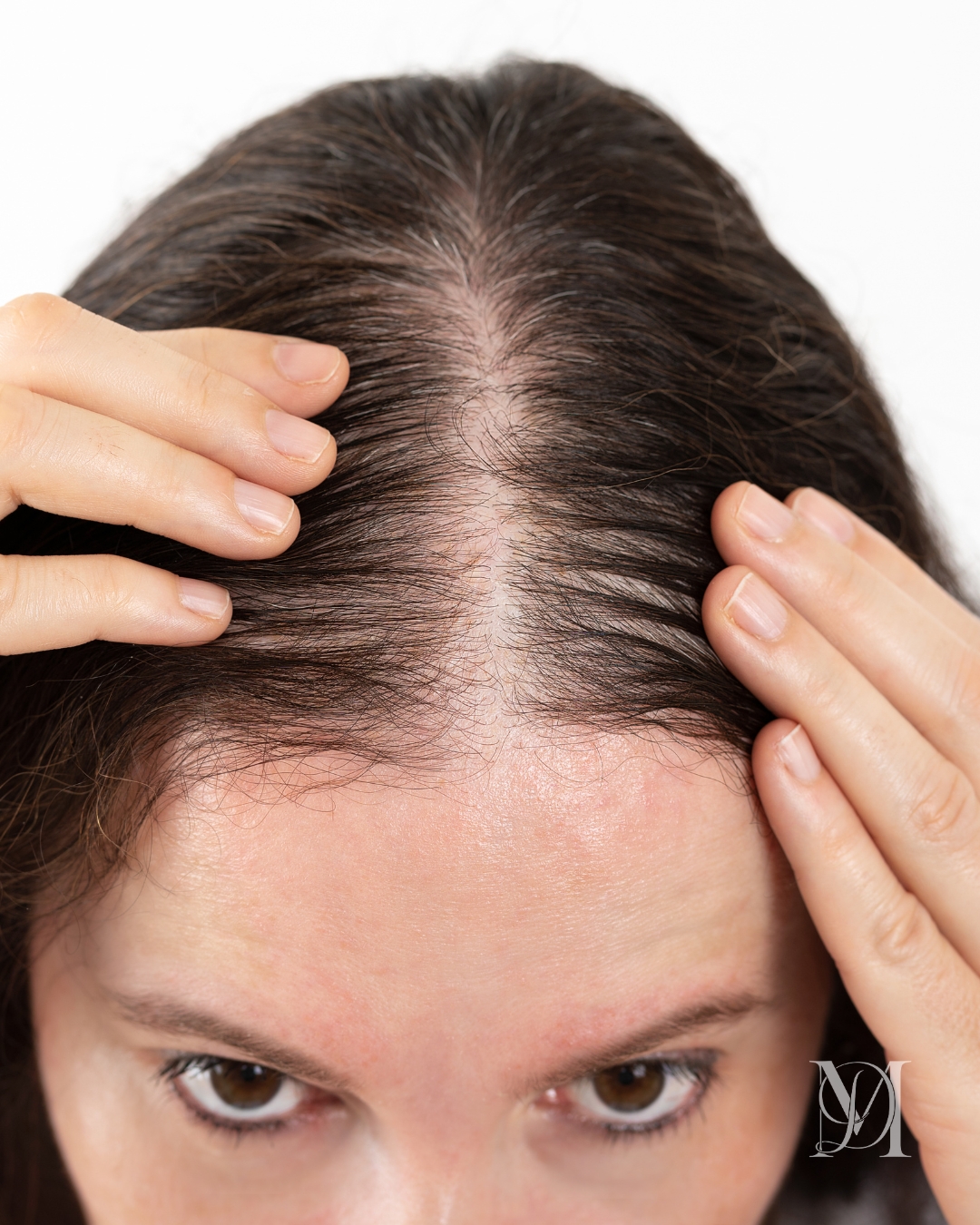 Overall Hair Thinning_smp