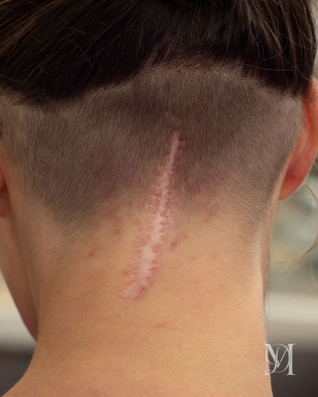 รอยแผลเป็นบนหัว_สักตอผม